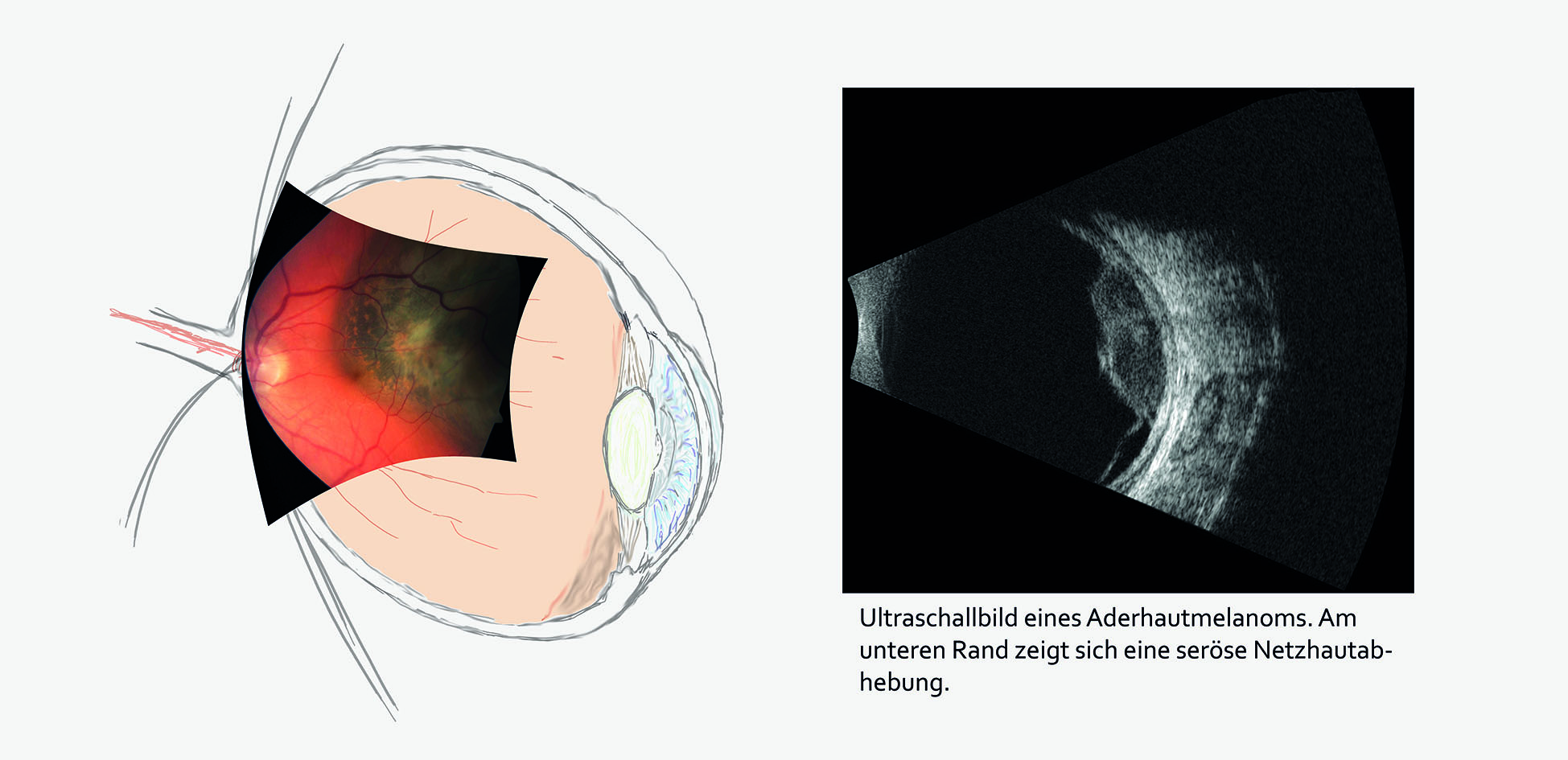 OCT Aufnahme des Glaskörpers in Abhebung im Bereich der Makula