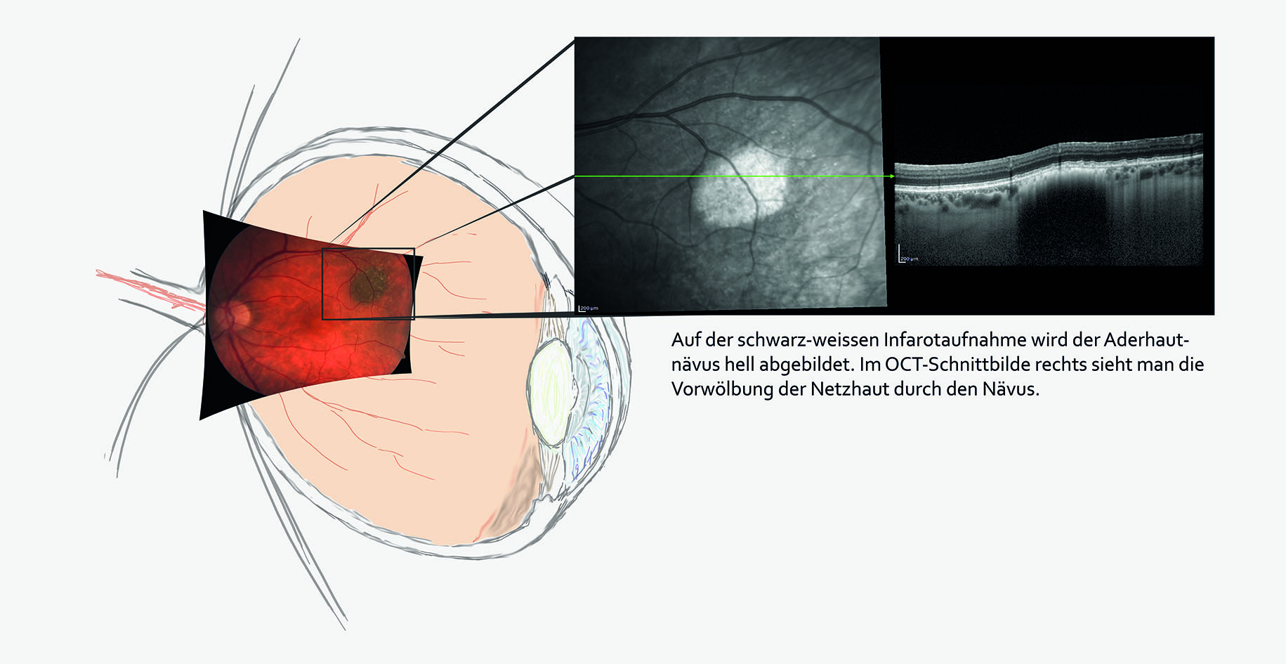 OCT Aufnahme des Glaskörpers in Abhebung im Bereich der Makula