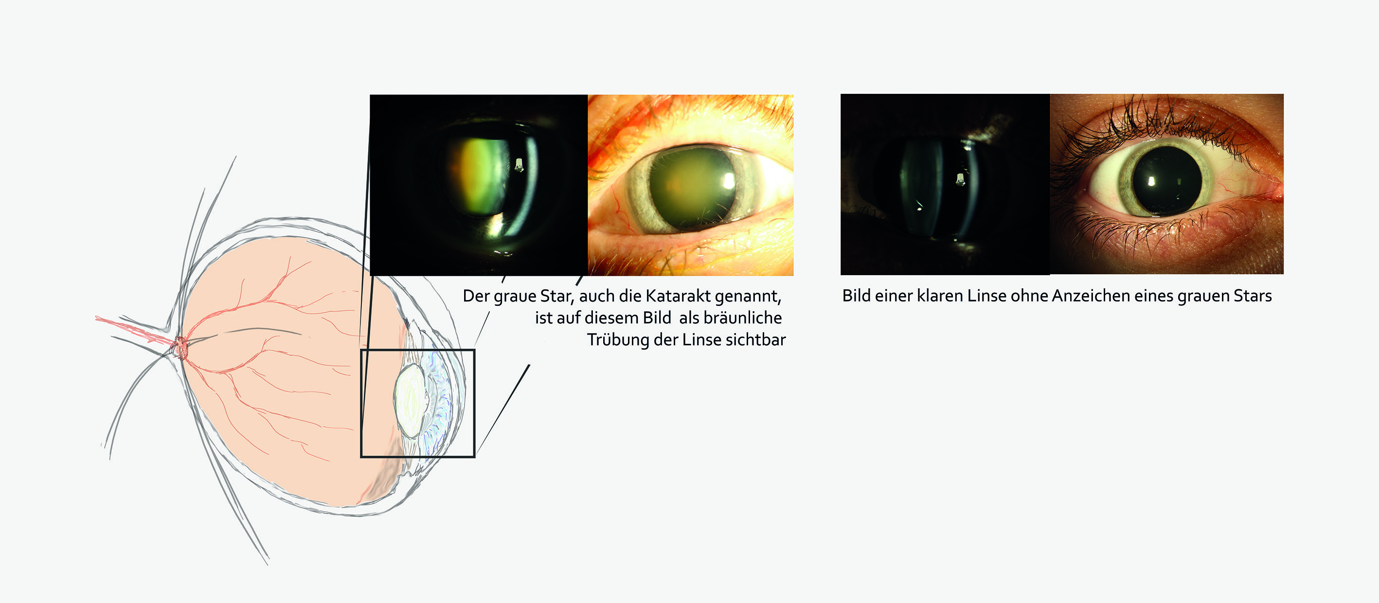 Grauer Star - Cataract