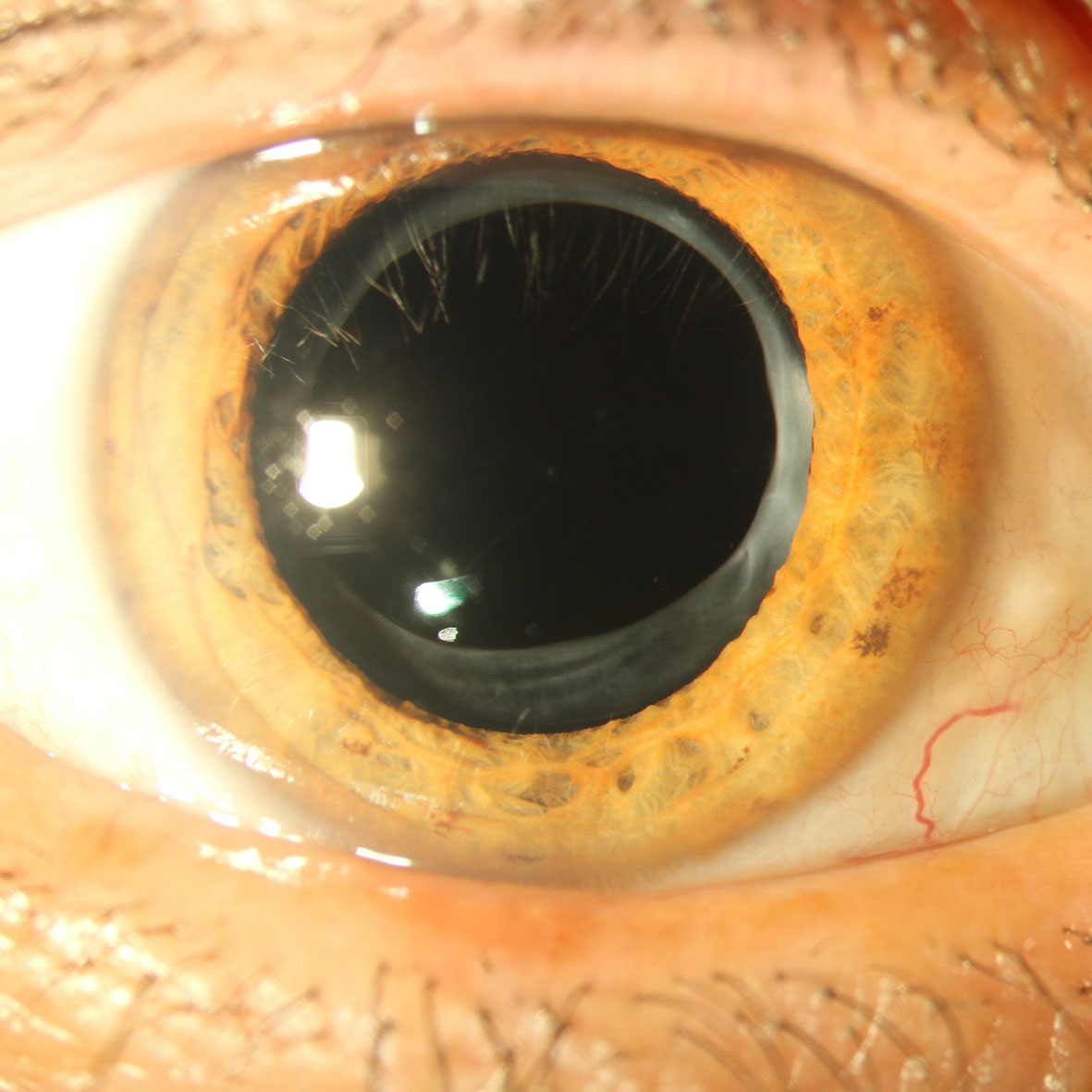 Auge nach Implantation einer klaren Kunstlinse
