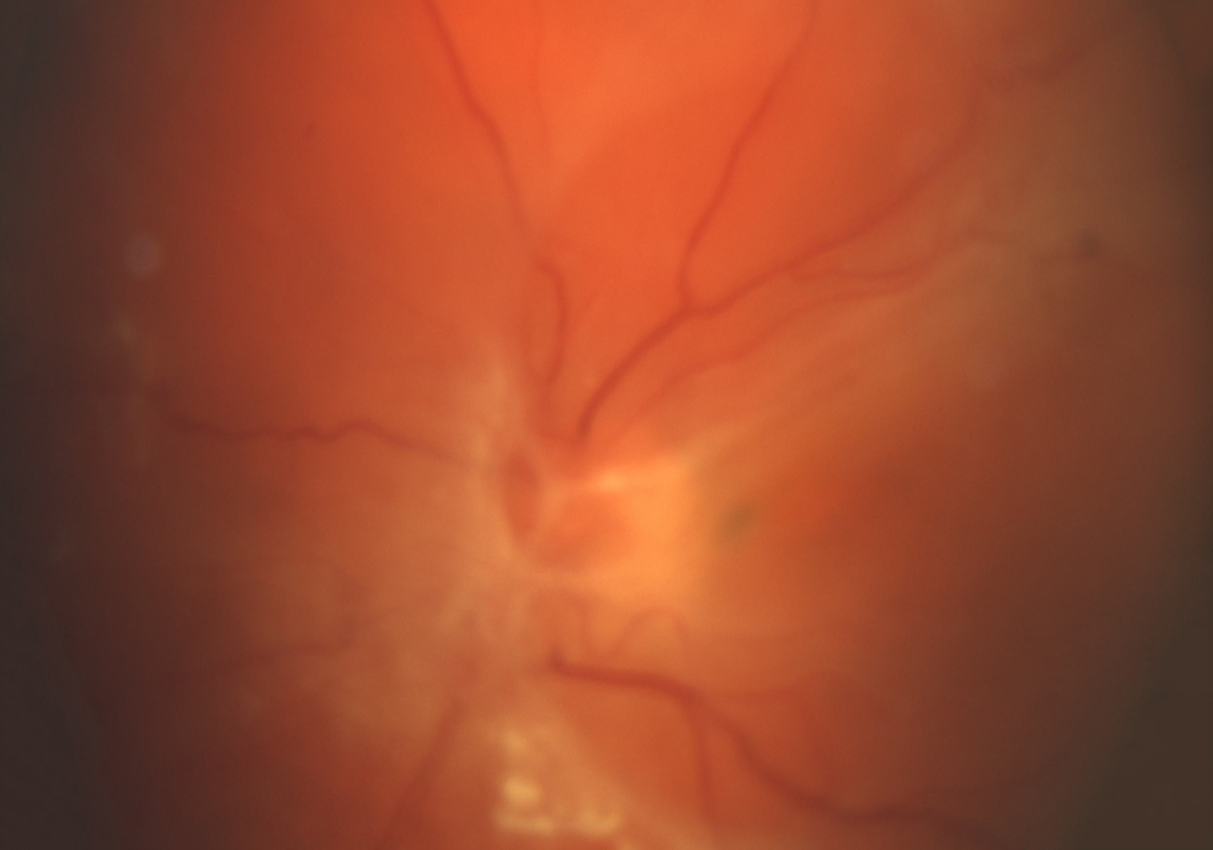 Traktive Netzhautablösung bei proliferativer diabetischer Retinopathie