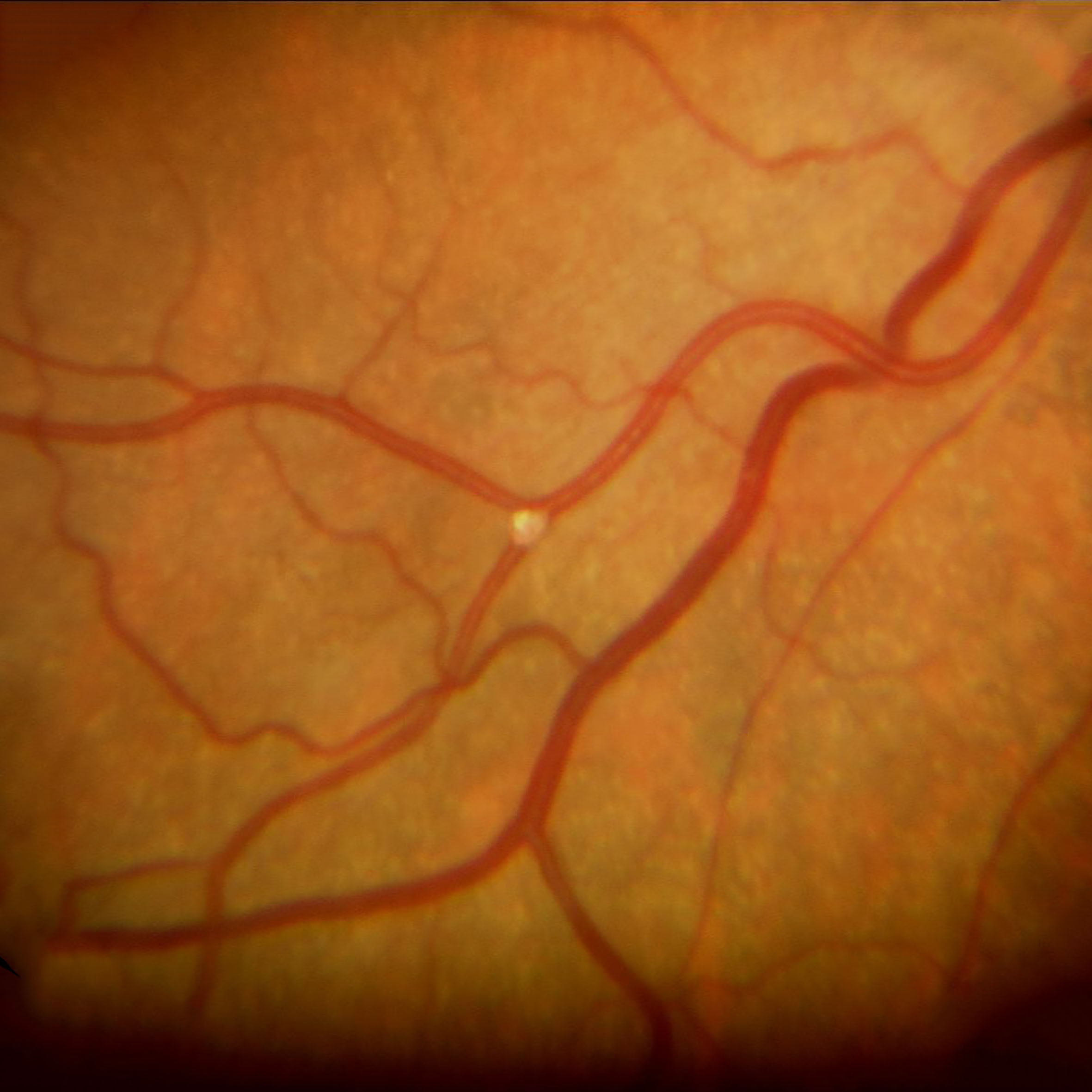 Verschluss eines retinalen Gefäßes durch einen weisslichen Embolus
